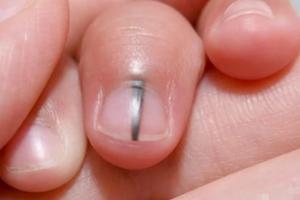 Nếu trong người có ung thư, 5 bộ phận này sẽ chuyển sang màu đen, tiếc rằng ít ai để ý!