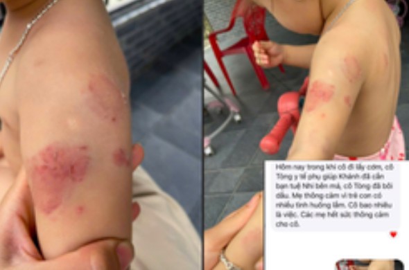 Bé 2 tuổi có vết cắn và bầm tím: Cha mẹ lo lắng về sự an toàn ở Trường