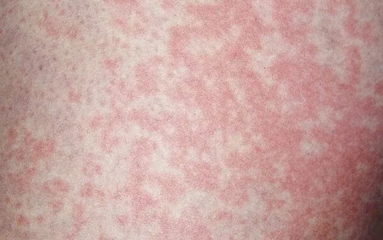 Người đàn ông nhiễm nấm vùng kín Do thói quen giặt chung đồ lót và tất