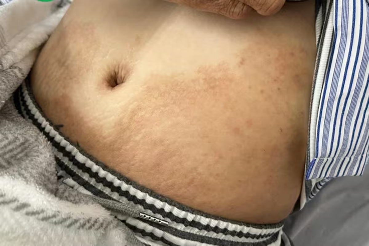 Thường xuyên ăn món vạn người mê, cô gái trẻ sốc khi biết nhiễm 4 loại ký sinh trùng