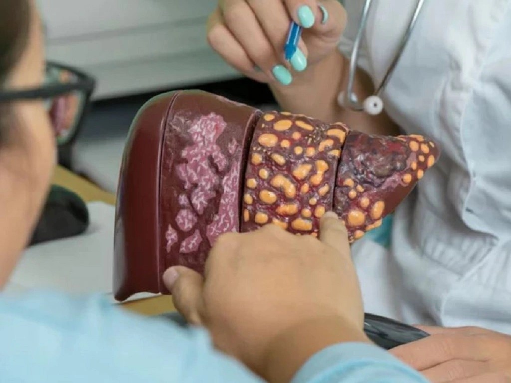 Chỉ cần thay đổi lối sống , giảm 48 % nguy cơ gan nhiễm mỡ và bệnh tim mạch