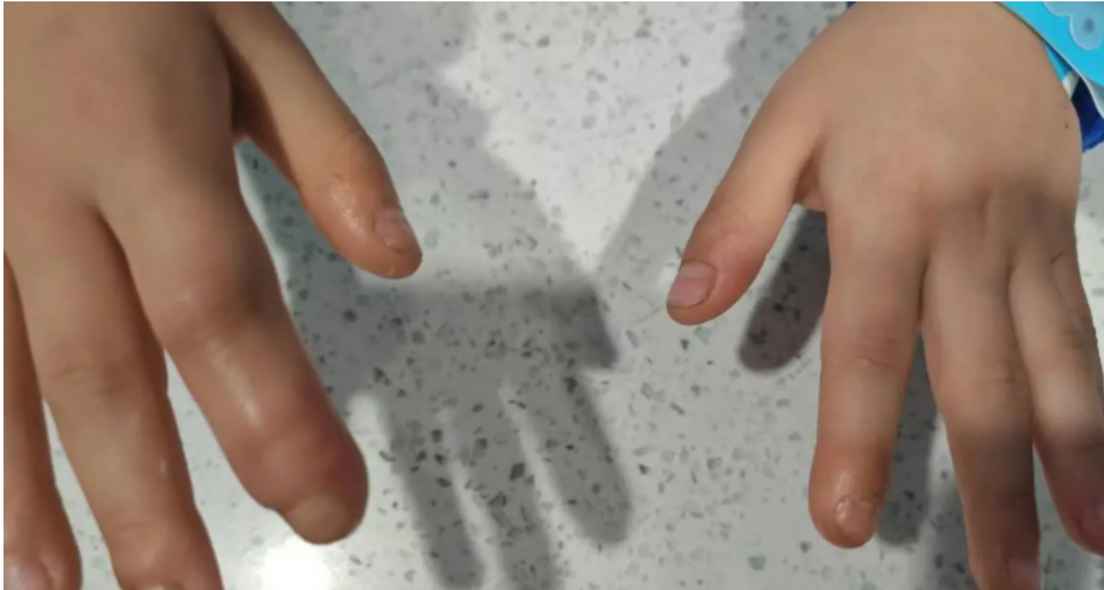 tre-hay-can-mong-tay-co-the-gay-nhiem-trung-nghiem-trong-bo-me-nen-can-than-2486.html