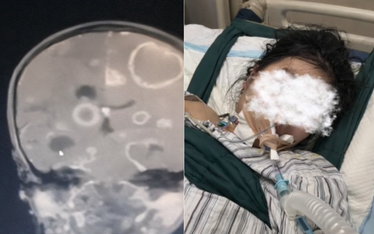 Dọn dẹp nhà đón Tết, bé gái lớp 2 bị ăn mòn 20 lỗ thủng ở não