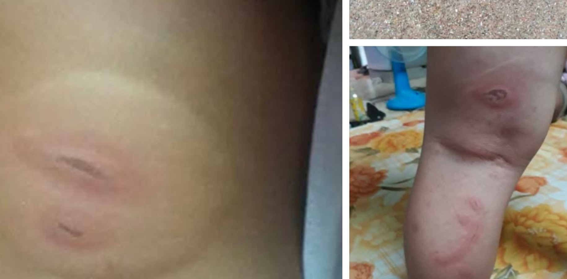 Thực hư thông tin bé 3 tuổi bị sâu biển cắn nguy kịch, gia đình tha thiết kêu gọi hỗ trợ máu hiếm