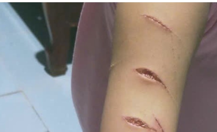 Học sinh lớp 5 bị chị họ dùng dao rạch tay: Nguyên nhân và hậu quả