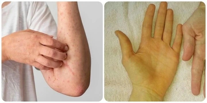 5 Dấu hiệu nhỏ trên da cảnh báo bệnh gan mà bạn không nên xem thường