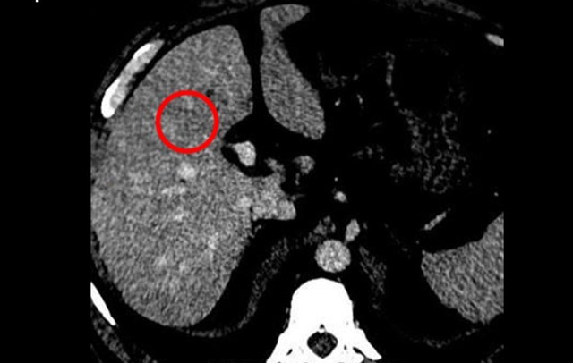 Tưởng đã kiểm soát viêm gan B , người đàn ông bất ngờ mắc ung thư gan