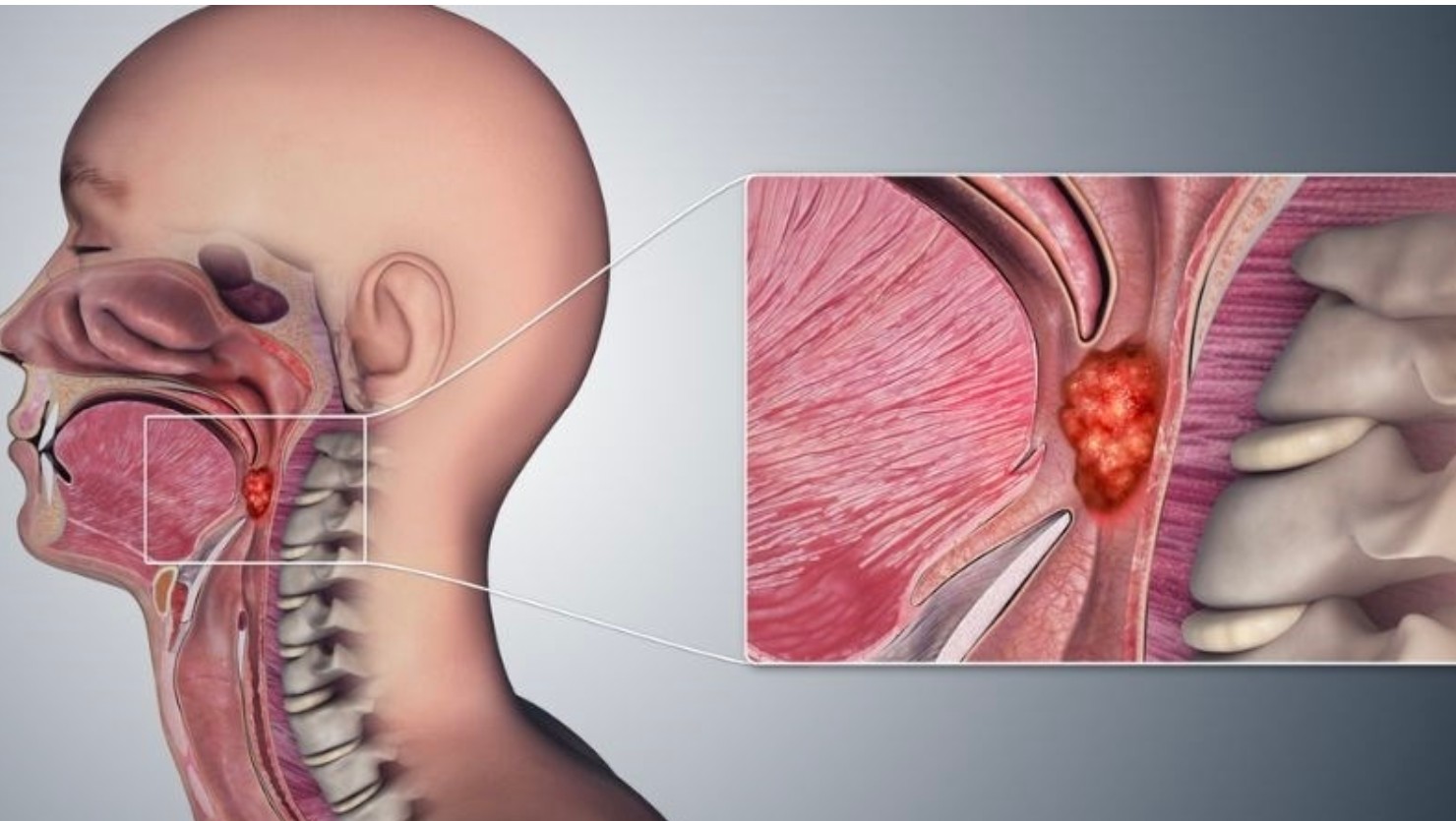Nghẹt mũi tưởng viêm xoang, sau 3 tháng người đàn ông 33 tuổi phát hiện mắc ung thư giai đoạn cuối: 3 dấu hiệu quen thuộc khiến nhiều người chủ quan!
