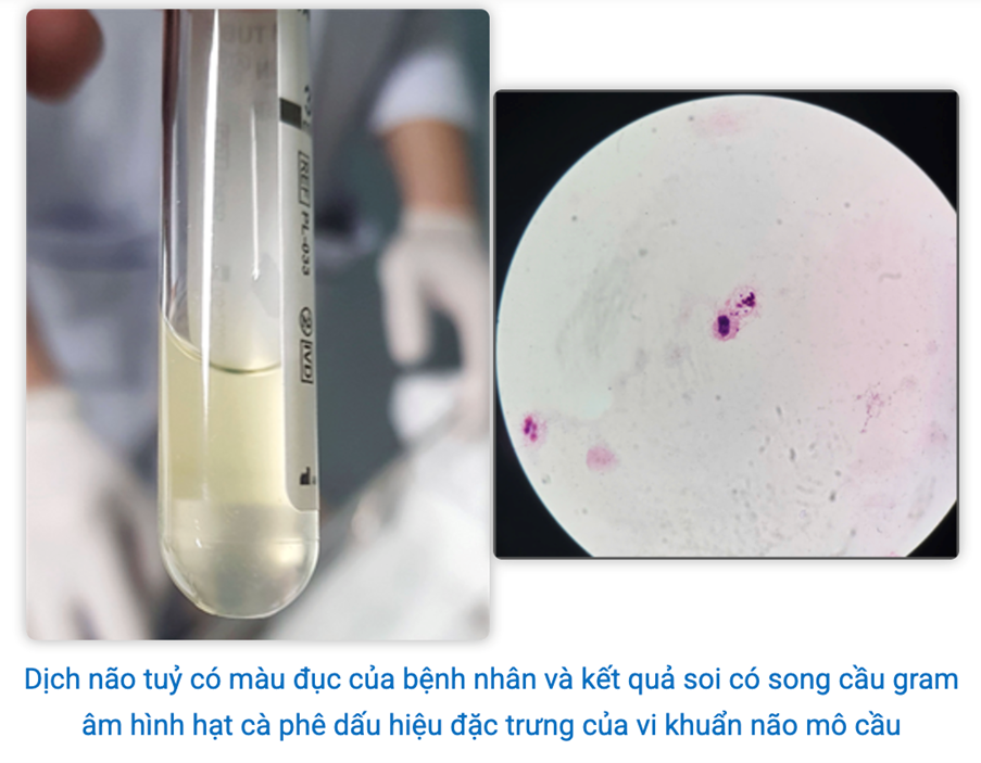 Ca bệnh do sát thủ 24 giờ não mô cầu gia tăng: Bác sĩ Bệnh viện Bạch Mai cảnh báo người lớn tuyệt đối không làm 1 việc khi ở gần trẻ