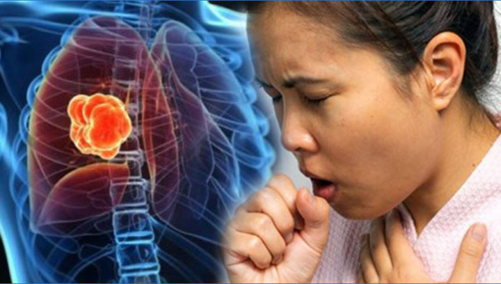 2 dấu hiệu khi ho cảnh báo ung thư phổi dễ bị bỏ qua