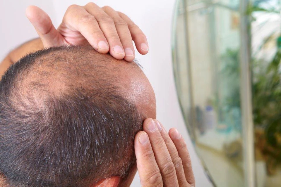 Ăn 3 quả trứng sống mỗi ngày để cứu tóc rụng, người đàn ông nhận cái kết bất ngờ