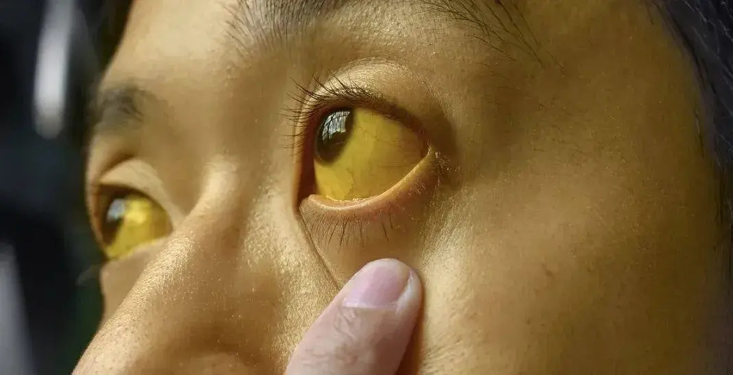 Nếu mắt có 6 thứ, đi khám ung thư ngay còn kịp!