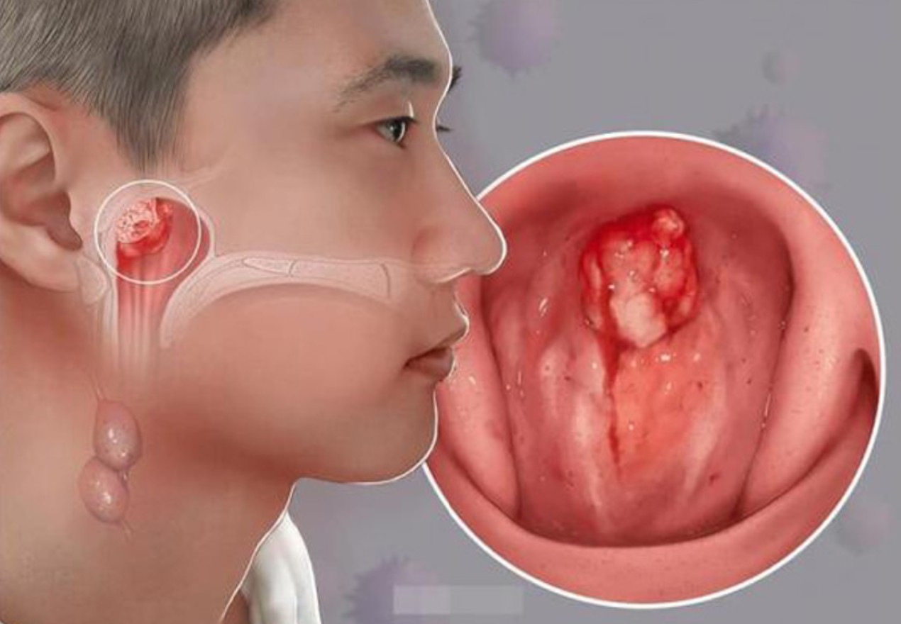 con-bi-u-tai-thoi-ma-va-cu-soc-cua-gia-dinh-khi-be-trai-14-tuoi-duoc-chan-doan-ung-thu-giai-doan-tien-trien-2603.html